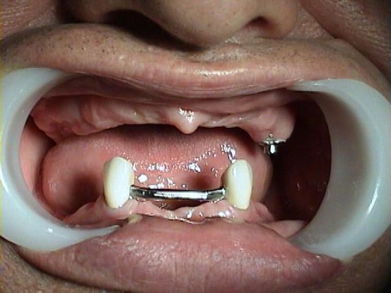 Ολική Οδοντοστοιχία άνω με σύνδεσμο ακριβείας στον 25